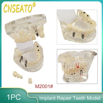 Модел възстановяване на зъбни импланти Изследване на заболявания мостовидного протеза Демонстрационен модел на зъбни импланти 2001 Медицински изследвания